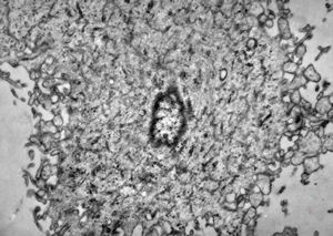 M,42y. | malignant mesothelioma - pleura